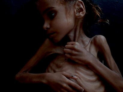 Amal Hussein, el rostro de la hambruna en Yemen fallecida hace unos días