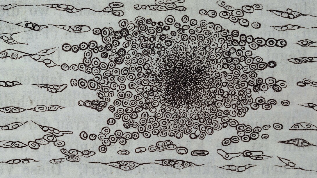 Figura 140 de la primera edición en alemán de la principal obra de Virchow: «Die Cellularpathologie» («Patología celular»)