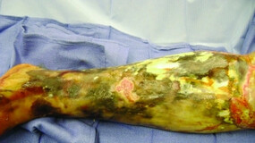 Fascitis necrotizante causada por Vibrio Vulnificus