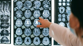 A Síndrome de Stiff-Person, também conhecida como Síndrome da Pessoa Rígida, é uma doença neurológica rara, crónica e potencialmente incapacitante. Ainda assim, permanece pouco conhecida fora dos círculos especializados. O resultado é previsível: anos de consultas, exames inconclusivos, diagnósticos fragmentados e uma sensação recorrente de não reconhecimento por parte de quem procura ajuda
