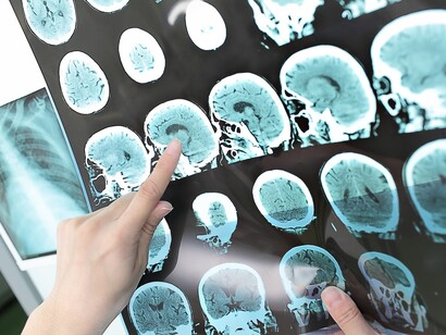 Radiografías de un paciente con esclerosis